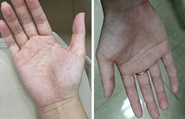 Bàn tay là tín hiệu cảnh báo sức khỏe: 1 thay đổi có thể cho thấy bệnh tiểu đường hoặc xơ gan- Ảnh 4.