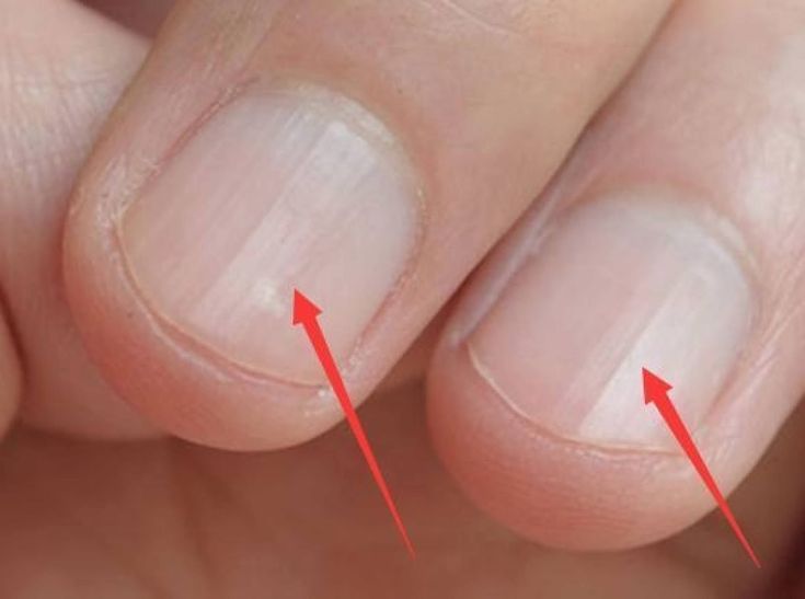 Bàn tay là tín hiệu cảnh báo sức khỏe: 1 thay đổi có thể cho thấy bệnh tiểu đường hoặc xơ gan- Ảnh 2.