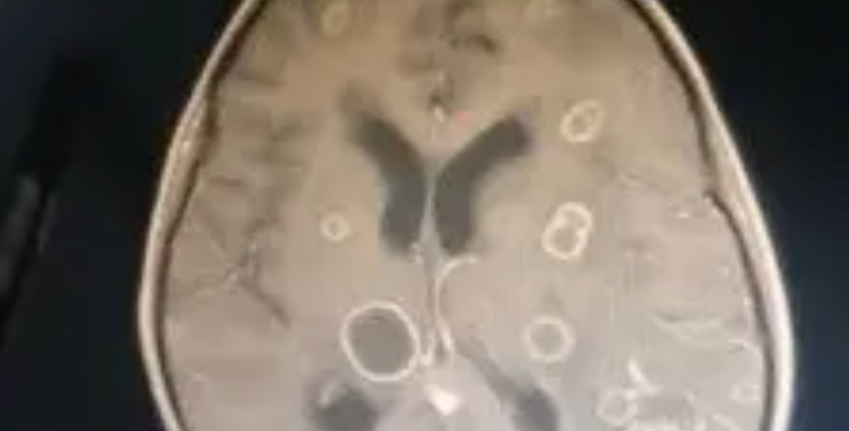 Dọn dẹp nhà đón Tết, bé gái lớp 2 bị "ăn mòn 20 lỗ thủng" ở não- Ảnh 1.