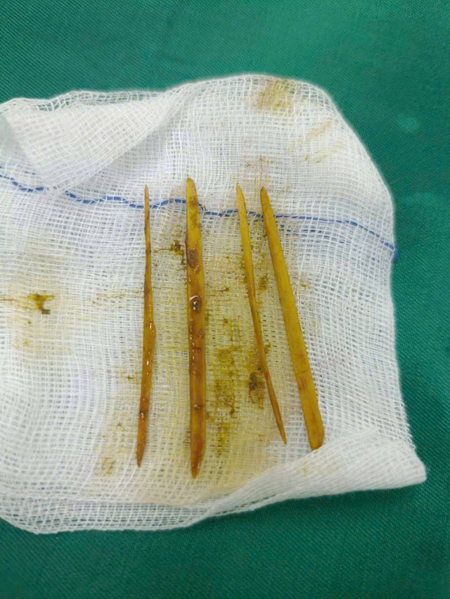 Cô gái 26 tuổi đau bụng dữ dội, bác sĩ sốc gắp ra thứ "đáng sợ" bên trong - Ảnh 2.