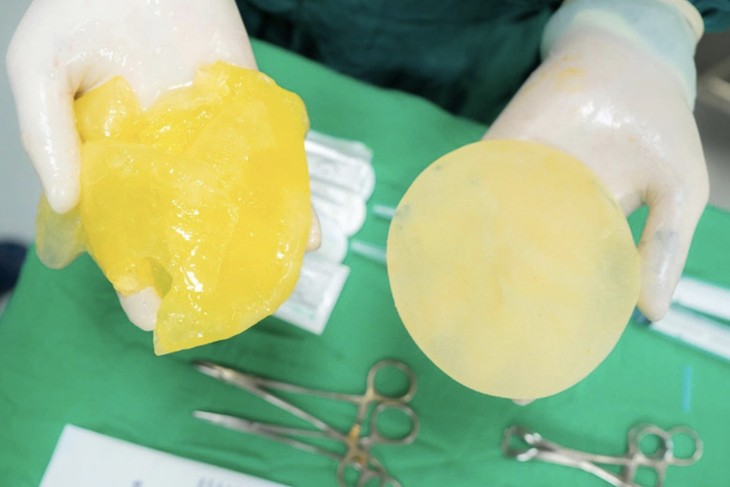 Bác sĩ cảnh báo: 5 Dấu hiệu vỡ túi ngực khi chơi pickleball cần chú ý - Ảnh 1. Bác sĩ cảnh báo: 5 Dấu hiệu vỡ túi ngực khi chơi pickleball cần chú ý - Ảnh 1.