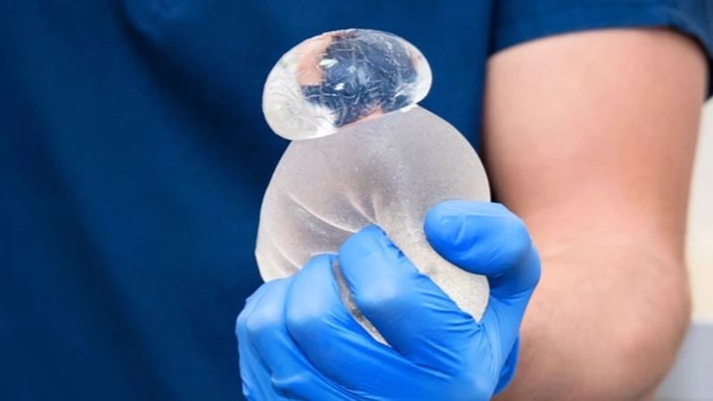 Bác sĩ cảnh báo: 5 Dấu hiệu vỡ túi ngực khi chơi pickleball cần chú ý - Ảnh 2. Bác sĩ cảnh báo: 5 Dấu hiệu vỡ túi ngực khi chơi pickleball cần chú ý - Ảnh 2.