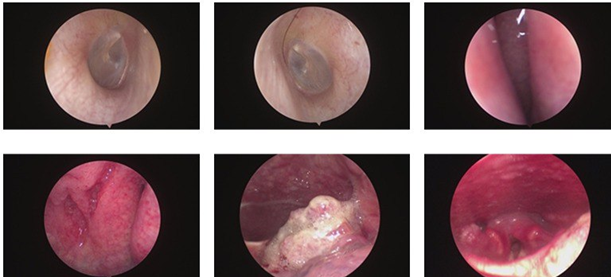 Sụt 5kg trong 1 tháng , người đàn ông 47 tuổi phát hiện ung thư thực quản nguy hiểm - Ảnh 2.