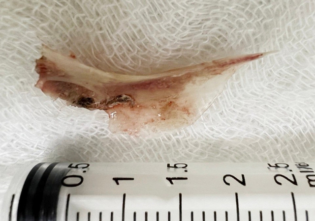 Hóc xương cá phải làm sao? 2 cách an toàn và hiệu quả bạn nên biết - Ảnh 3.