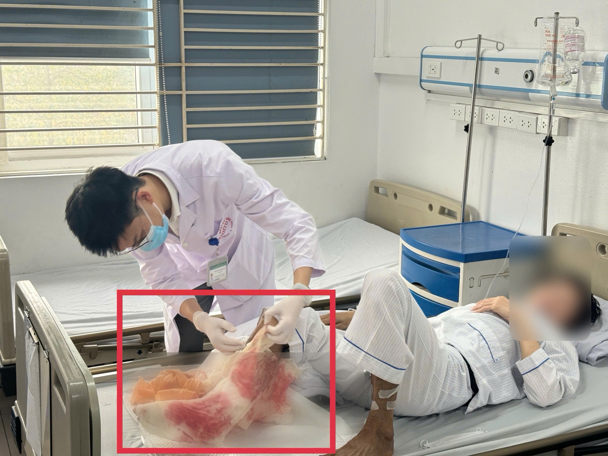 Chữa bỏng bằng lá có thể gây họai tử nghiêm trọng như trường hợp ở Tuyên Quang - Ảnh 1.