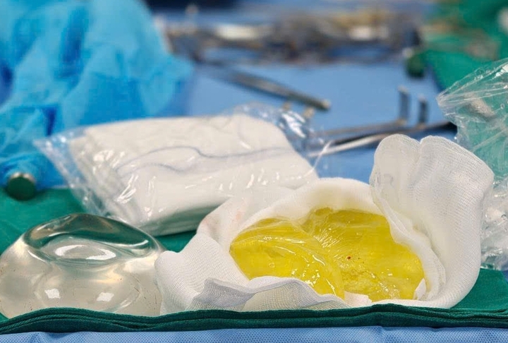 Vỡ túi ngực khi không hay biết: Những điều cần lưu ý năm 2026 - Ảnh 1. Vỡ túi ngực khi không hay biết: Những điều cần lưu ý năm 2026 - Ảnh 1.