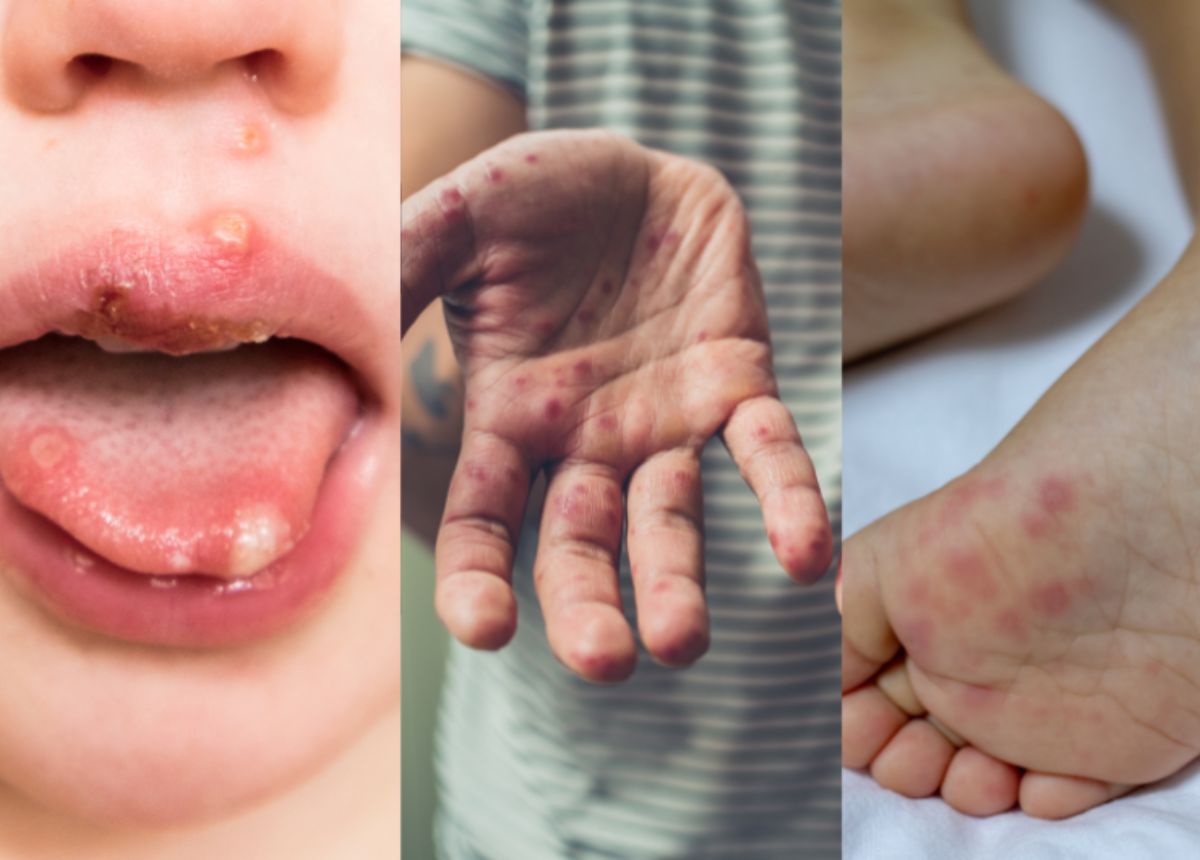 Bệnh tay chân miệng 2026: Dấu hiệu nguy hiểm Cha mẹ cần biết NGAY để bảo vệ trẻ - Ảnh 2. Bệnh tay chân miệng 2026: Dấu hiệu nguy hiểm Cha mẹ cần biết NGAY để bảo vệ trẻ - Ảnh 2.