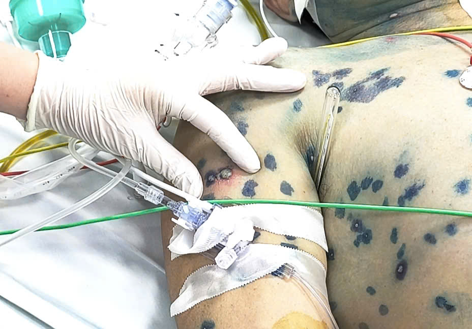 Thủy đậu người lớn Ngày càng nguy hiểm: Cảnh báo từ Bệnh viện bệnh Nhiệt đới Trung ương - Ảnh 2. Thủy đậu người lớn Ngày càng nguy hiểm: Cảnh báo từ Bệnh viện bệnh Nhiệt đới Trung ương - Ảnh 2.