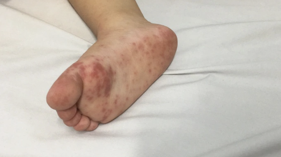 Dịch tay chân miệng “nóng” trở lại, trẻ nhỏ đối mặt nguy cơ biến chứng nặng - Ảnh 2.