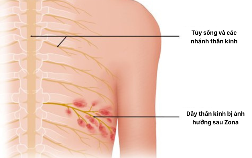 Khảo sát cho thấy 78 % người lớn tuổi lo sợ bệnh zona ảnh hưởng đến cuộc sống - Ảnh 2. Khảo sát cho thấy 78 % người lớn tuổi lo sợ bệnh zona ảnh hưởng đến cuộc sống - Ảnh 2.