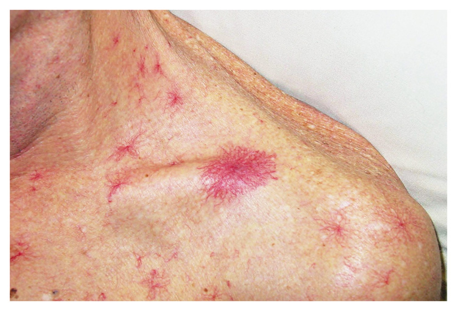 5 Dấu hiệu bệnh gan trên da bạn không nên xem thường năm 2026 - Ảnh 2. 5 Dấu hiệu bệnh gan trên da bạn không nên xem thường năm 2026 - Ảnh 2.