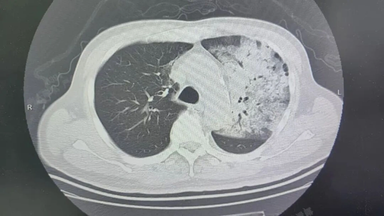 Người đàn ông sốt 40 độ C, phổi gần như “trắng xóa”, chỉ vài ngày đã suy đa tạng: Thủ phạm liên quan đến thói quen nhiều gia đình vẫn mắc - Ảnh 1.
