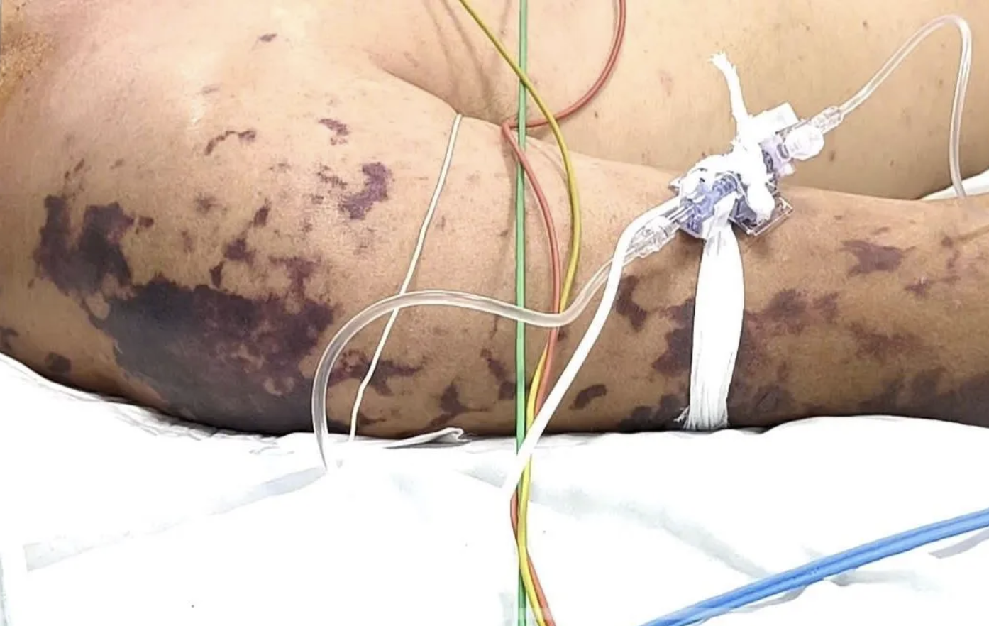 4 ca tử vong do não mô cầu, Bộ Y tế cảnh báo nguy cơ - Ảnh 1.