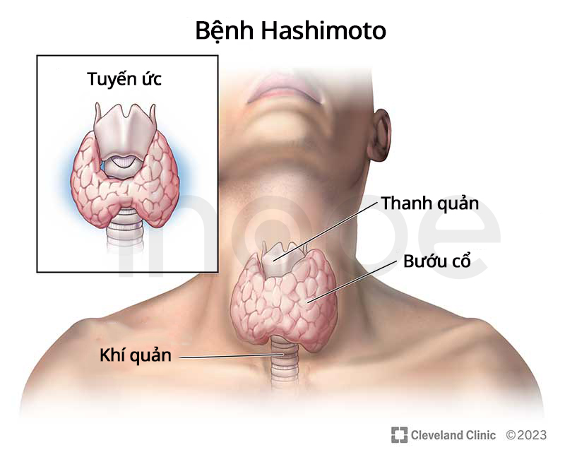 Nữ diễn viên 36 tuổi tiết lộ "mắc bệnh Hashimoto", phải từ bỏ đồ ăn ngoài để giữ sức khỏe: Căn bệnh thường gặp ở phụ nữ, không thể chữa khỏi - Ảnh 4.