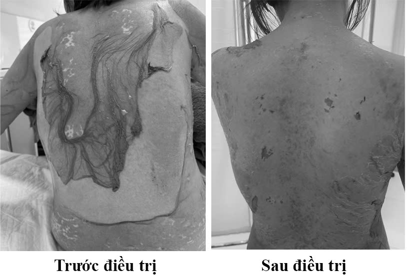 Hải Phòng: 1 phụ nữ 35 tuổi bị tróc da như "cua lột" vì thói quen dùng thuốc cực kỳ phổ biến - Ảnh 1.