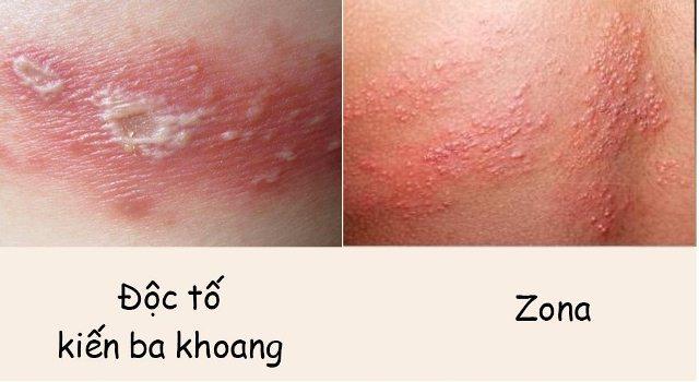 Bác sĩ BV Bạch Mai cảnh báo căn bệnh viêm da do một loại côn trùng gây ra: Cực độc, rất dễ nhầm lẫn với bệnh Zona và gặp nhiều vào mùa hè - Ảnh 2.