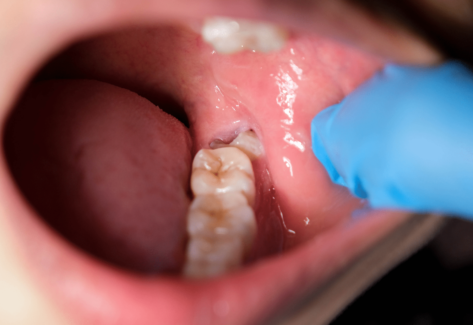 Trì hoãn nhổ răng khôn sau tuổi 35 và nguy cơ biến chứng thần kinh tăng cao - Ảnh 4. Trì hoãn nhổ răng khôn sau tuổi 35 và nguy cơ biến chứng thần kinh tăng cao - Ảnh 4.