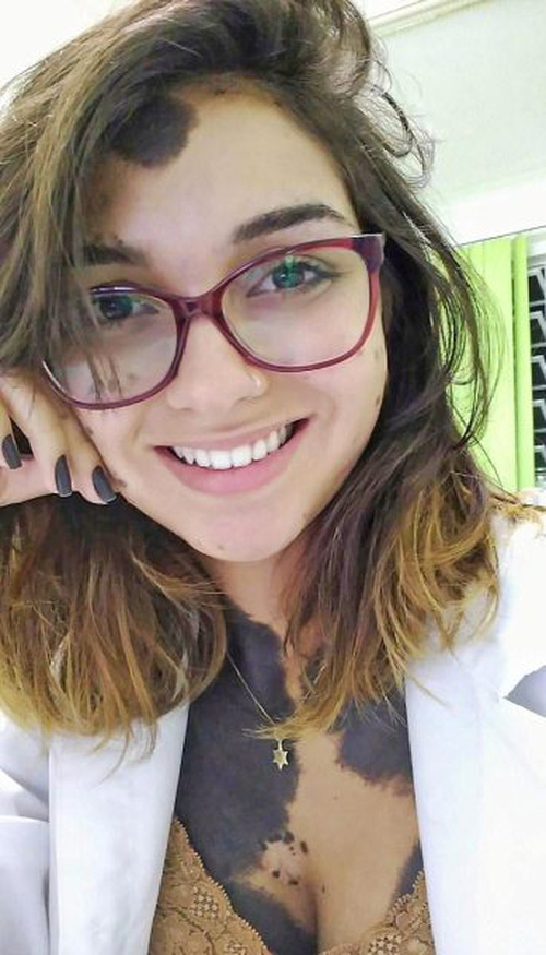 Cô gái trẻ tự tin với những vết chàm lớn chiếm 80% diện tích cơ thể - Ảnh 1. Cô gái trẻ tự tin với những vết chàm lớn chiếm 80% diện tích cơ thể - Ảnh 1.