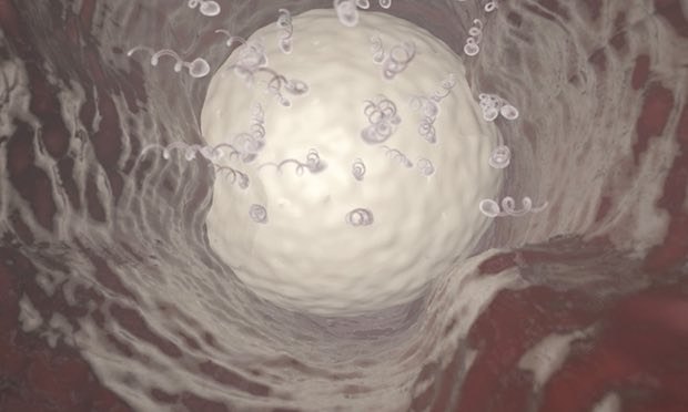 Vasalgel chặn sự di chuyển của tinh trùng trong ống dẫn tinh