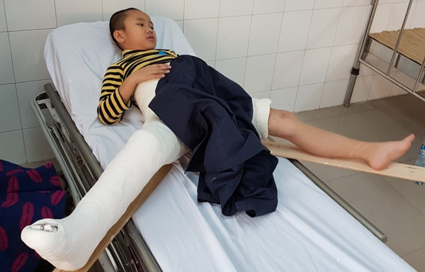 
Học sinh Trần Chí Kiên, học sinh lớp 2A4, trường tiểu học Nam Trung Yên, quận Cầu Giấy bị gãy xương đùi tại trường. Ảnh: VOV
