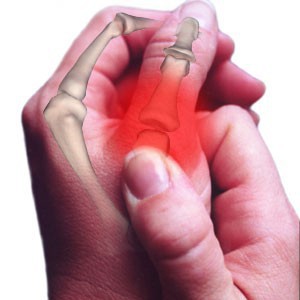 Khớp xương nóng, đỏ hoặc đau có thể do bệnh gút.