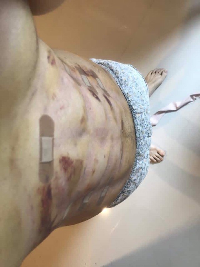 Trào lưu phẫu thuật thẩm mỹ mới: Body 6 múi sexy không cần phải tập cũng có! - Ảnh 13.