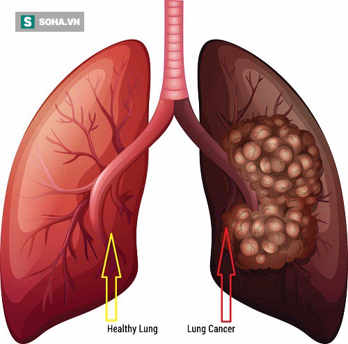 Ung thư phổi gây tử vong số 1: Những dấu hiệu cảnh báo sớm tuyệt đối không nên lờ đi  - Ảnh 1.