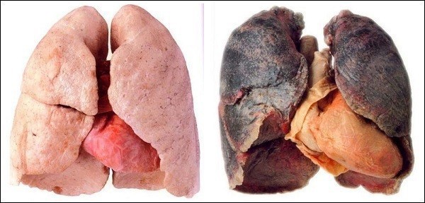 Ung thư phổi gây tử vong số 1: Những dấu hiệu cảnh báo sớm tuyệt đối không nên lờ đi  - Ảnh 2.