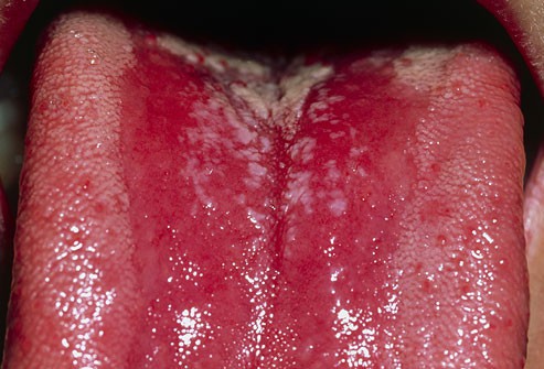 10 bệnh thường gặp ở miệng: Cái số 5 và 6 có thể biến thành ung thư, ai cũng nên cảnh giác - Ảnh 2.
