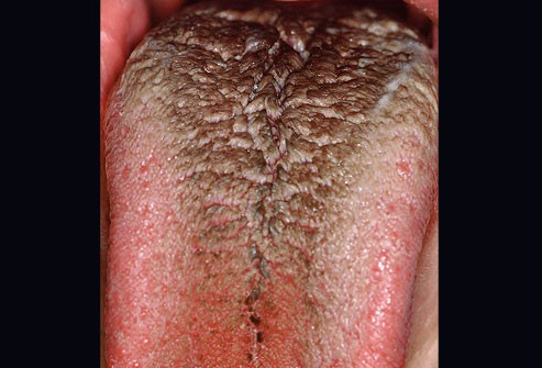 10 bệnh thường gặp ở miệng: Cái số 5 và 6 có thể biến thành ung thư, ai cũng nên cảnh giác - Ảnh 3.