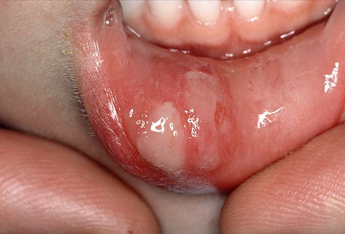 10 bệnh thường gặp ở miệng: Cái số 5 và 6 có thể biến thành ung thư, ai cũng nên cảnh giác - Ảnh 4.