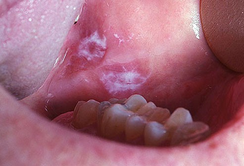 10 bệnh thường gặp ở miệng: Cái số 5 và 6 có thể biến thành ung thư, ai cũng nên cảnh giác - Ảnh 5.