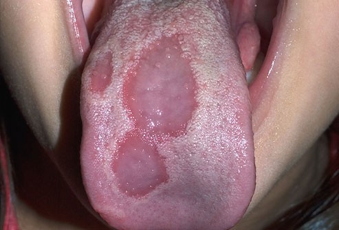 10 bệnh thường gặp ở miệng: Cái số 5 và 6 có thể biến thành ung thư, ai cũng nên cảnh giác - Ảnh 7.