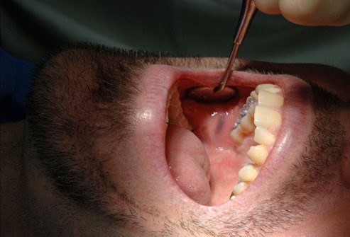 10 bệnh thường gặp ở miệng: Cái số 5 và 6 có thể biến thành ung thư, ai cũng nên cảnh giác - Ảnh 10.