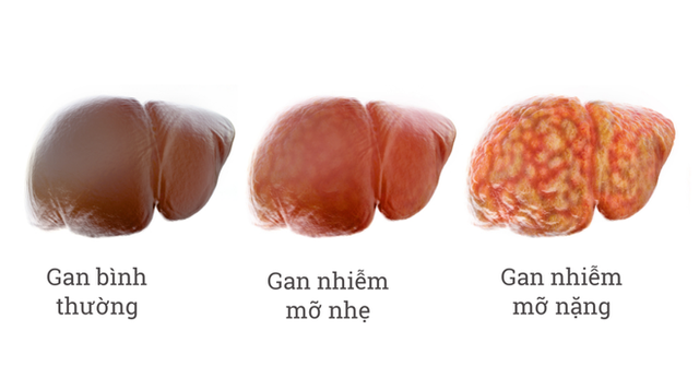 Nguyên nhân hình thành bệnh gan nhiễm mỡ: Dù ở lứa tuổi nào bạn cũng nên biết để tránh - Ảnh 1. Nguyên nhân hình thành bệnh gan nhiễm mỡ: Dù ở lứa tuổi nào bạn cũng nên biết để tránh - Ảnh 1.