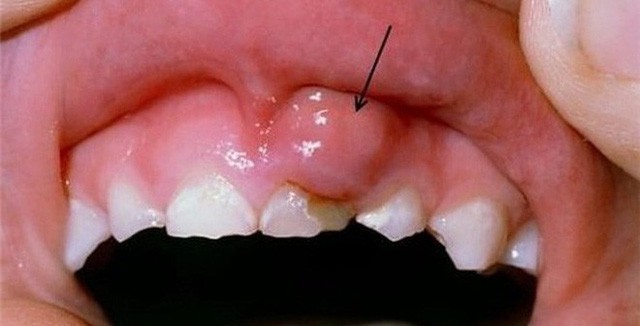  6 vấn đề sức khỏe ở vùng răng miệng mà không phải ai cũng biết, đặc biệt là cái số 3  - Ảnh 3.