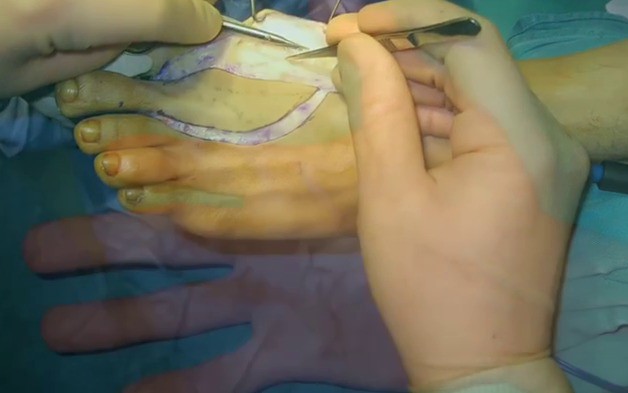 Việt Nam thực hiện thành công phẫu thuật siêu khó tầm cỡ quốc tế: lấy ngón CHÂN cái thay cho ngón TAY cái để phục hồi chức năng bàn tay! - Ảnh 1.