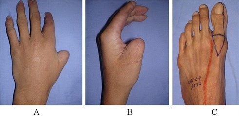 Việt Nam thực hiện thành công phẫu thuật siêu khó tầm cỡ quốc tế: lấy ngón CHÂN cái thay cho ngón TAY cái để phục hồi chức năng bàn tay! - Ảnh 9.