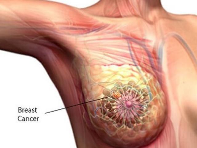  Cô gái 22 tuổi phát hiện ung thư vú: Mong mọi người hãy làm điều này để tránh bệnh ung thư - Ảnh 2.