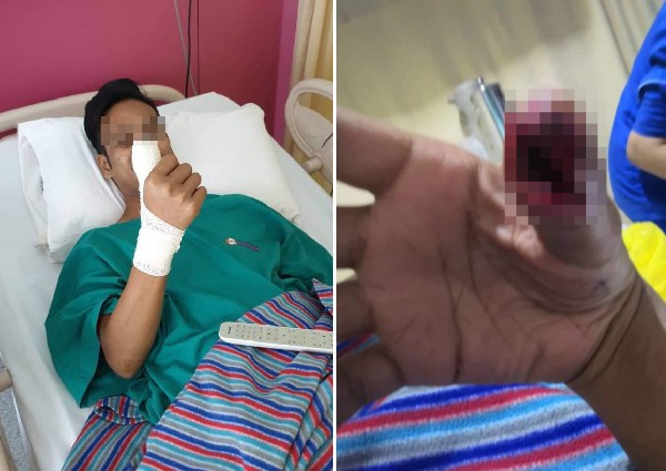 Chơi game 4 tháng liên tiếp trên smartphone rạn kính, thanh niên Malaysia suýt phải cắt bỏ ngón tay cái vì nhiễm trùng - Ảnh 1.