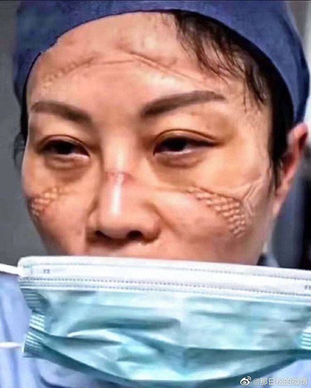 Gương mặt đầy vết hằn do khẩu trang, kính bảo hộ: Các y tá, bác sĩ ở Vũ Hán đã đánh cược cả tính mạng để chống lại đại dịch corona - Ảnh 3.