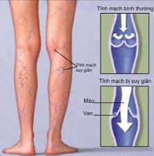 Nổi gân xanh trên cơ thể, chỉ điểm bệnh gì? - Ảnh 1. Nổi gân xanh trên cơ thể, chỉ điểm bệnh gì? - Ảnh 1.
