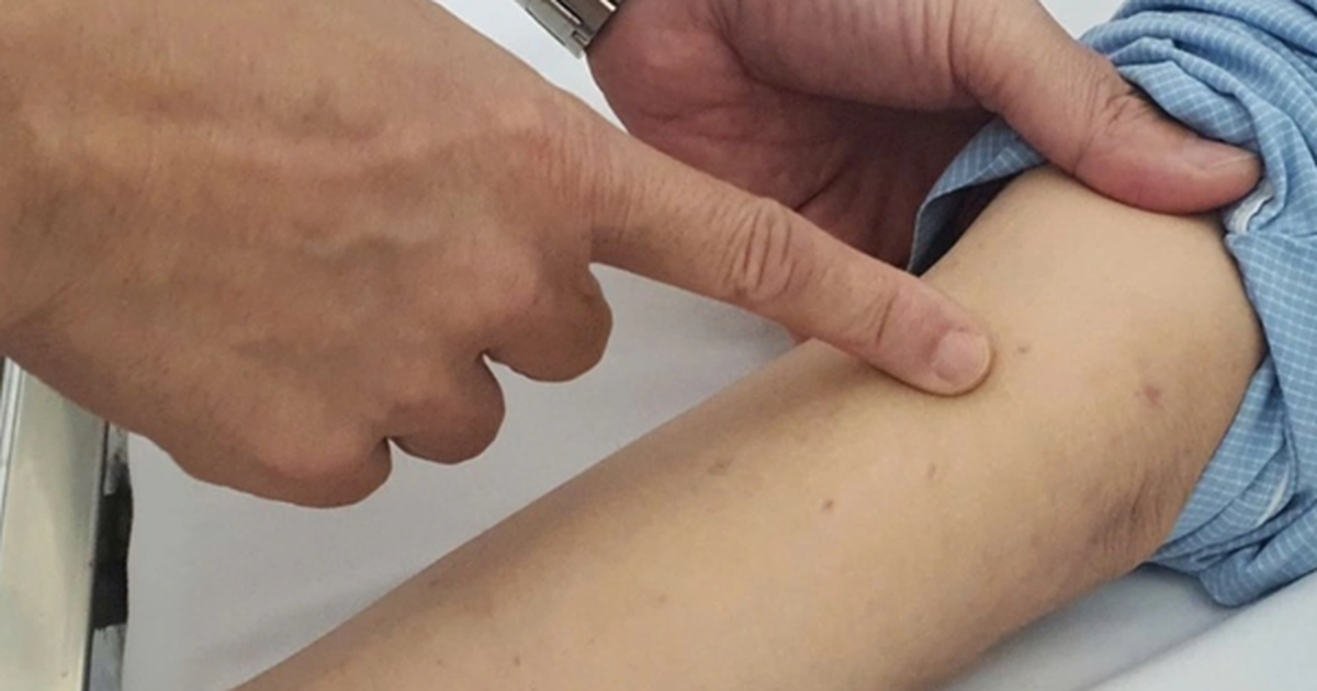 Gần 40.000 mũi vaccine não mô cầu được tiêm trên toàn quốc trong 4 ngày