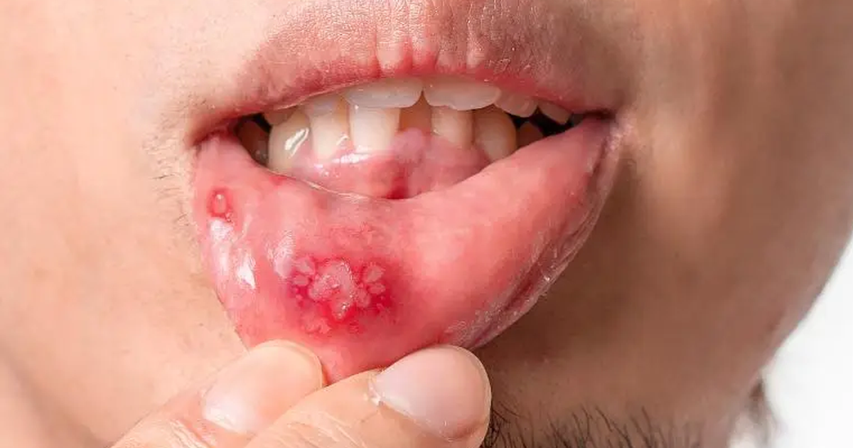 Cơ thể bạn không biết nói dối: 3 dấu hiệu phổ biến của hệ miễn dịch suy yếu, hãy xem bạn có bao nhiêu trong số đó