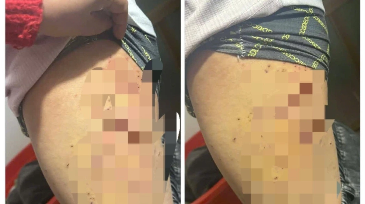 Nữ sinh lớp 7 bị bạn dùng bút bi đâm chi chít vào đùi