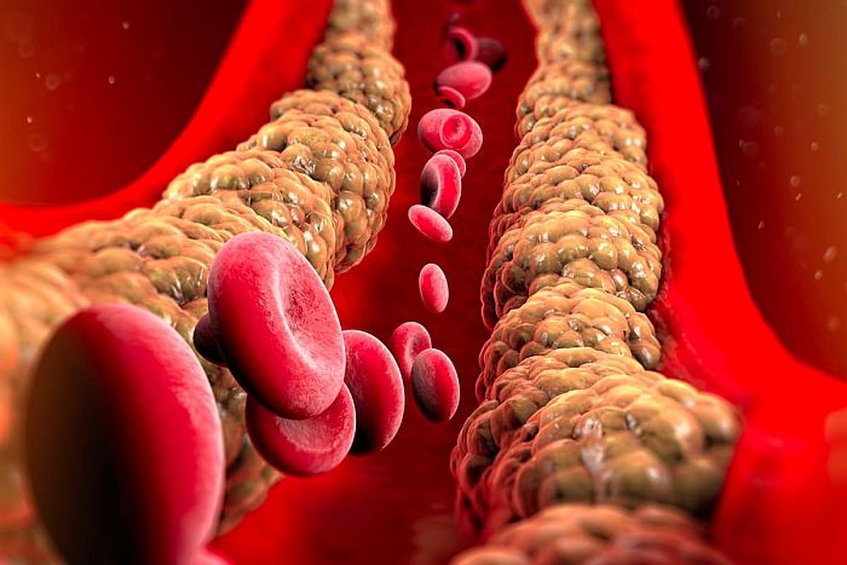 Cholesterol "tốt" và "xấu" khác nhau thế nào? Làm sao để giảm mỡ máu "xấu", tăng mỡ máu "tốt"?