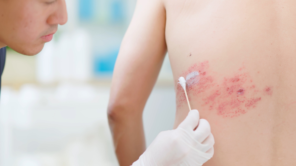 Chuyên gia cảnh báo: Hơn 90% người Việt Nam trưởng thành mang sẵn virus này, cứ 3 người thì có 1 người phát bệnh