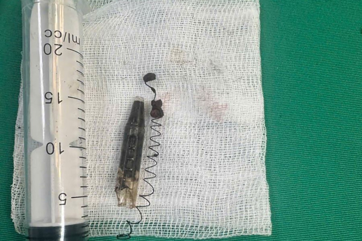 13 năm bị găm đầu bút bi ở vùng thái dương chỉ vì một lần nô đùa: Bác sĩ cảnh báo không thể chủ quan với vết thương nhỏ