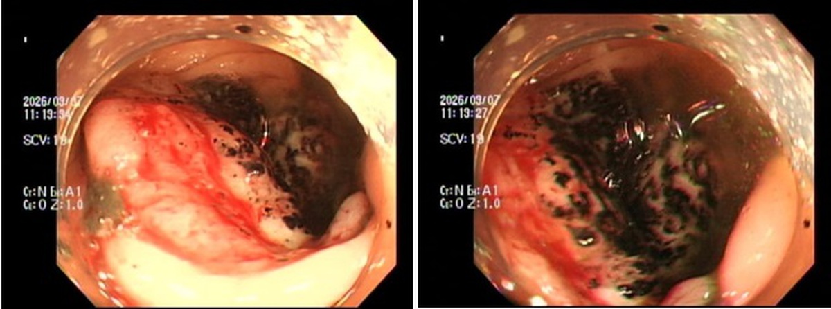 Ngày càng nhiều người trẻ bị ung thư đại trực tràng, Bệnh viện Nhân dân 115 đưa ra khuyến cáo KHẨN