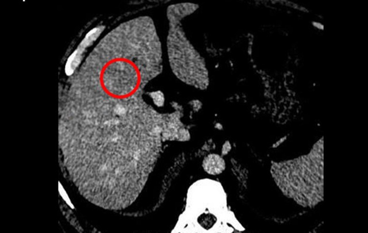 Tưởng đã kiểm soát viêm gan B, người đàn ông nhận ‘án’ UNG THƯ vì thói quen nhiều người mắc